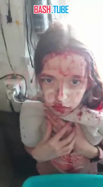  В Башкортостане собака растерзала лицо десятилетней девочки