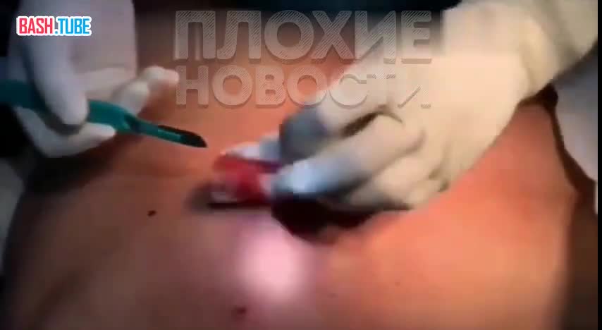  Российский военный получил страшное ранение в грудь, но выжил