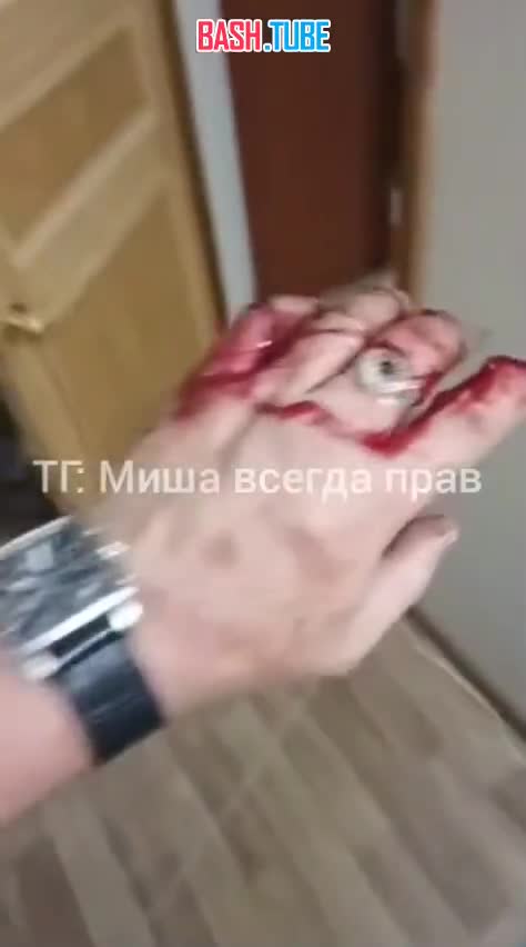  Во Владивостоке мужчина лишился пальца, когда разнимал собачью драку