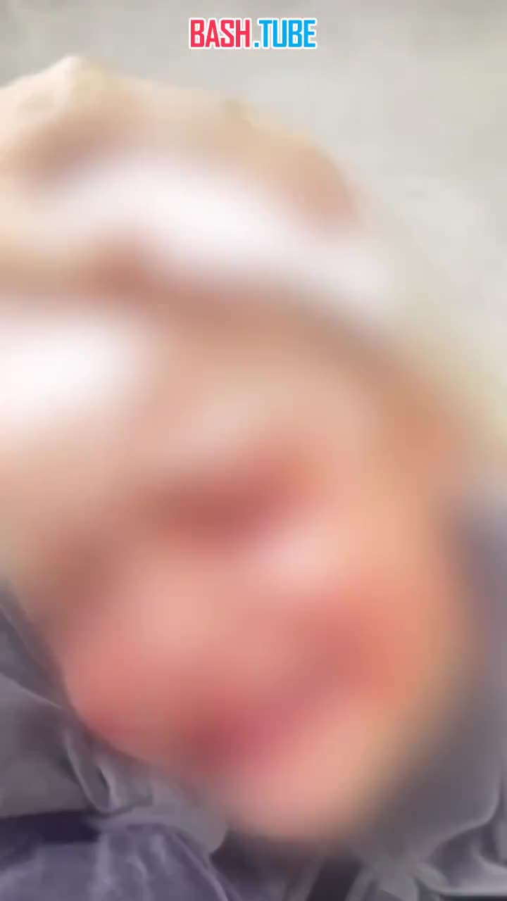  В Тюмени бойцовская собака напала на маленькую девочку и едва не разорвала ей лицо