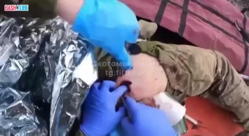  Боец ВСУ попал под обстрел и получил огромную дыру на ягодице