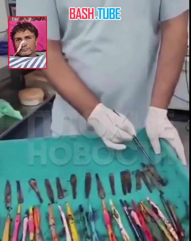  В Индии хирурги извлекли из желудка мужчины 29 ложек, 19 зубных щеток и 2 ручки