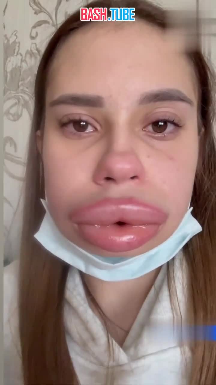  Девушка из Владикавказа хотела «сдуть» накаченные губы, но они стали только больше: у пациентки начался отек Квинке