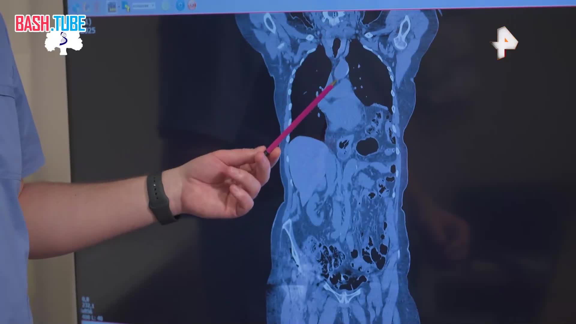  Женщину, у которой все органы расположены в грудной клетке, прооперировали с помощью робота в Москве