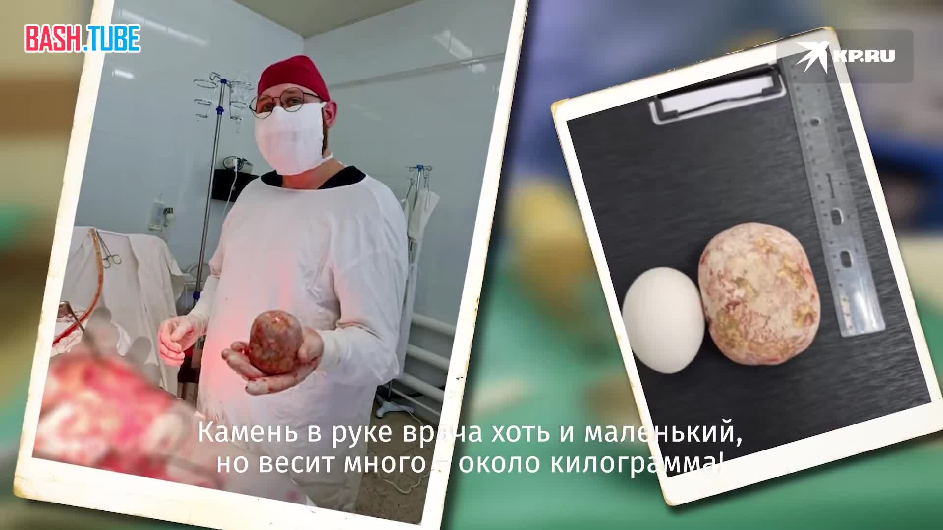  В Балаково, Саратовской области хирурги удалили из мочевого пузыря пациента камень весом около килограмма