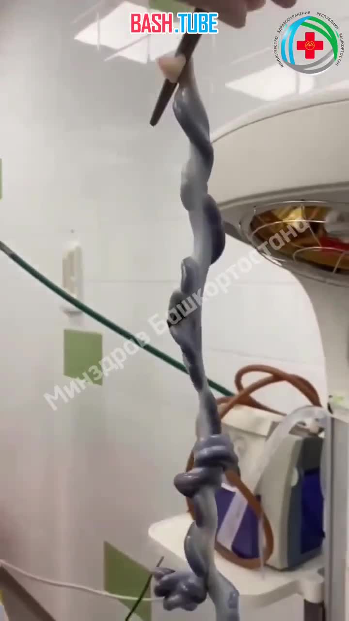  Ребёнок с полутораметровой пуповиной родился в Башкирии