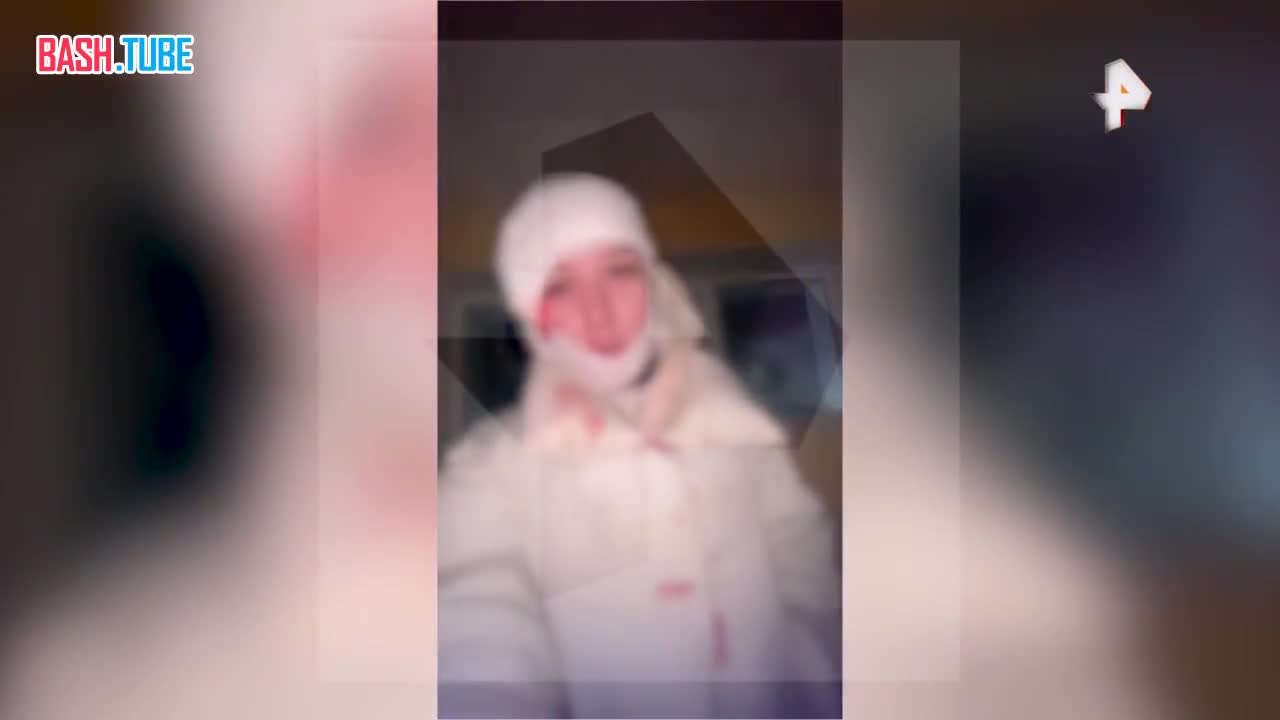  Девушка получила арматурой по лицу в канун Нового года, защищая парня в Ленинградской области, рассказал РЕН ТВ